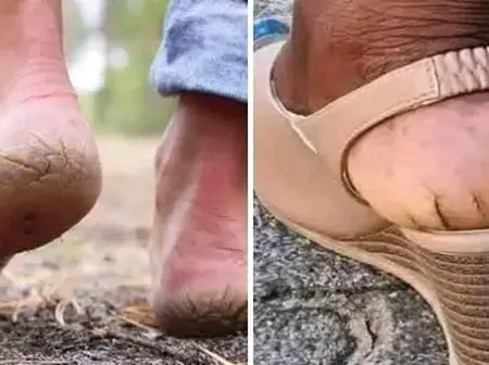 How Can You Remove Hard Skin On Your Feet? Simple Solution To Try & Thank Me Later
